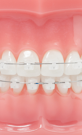 Bild_Aesthetische_Zahnspangen